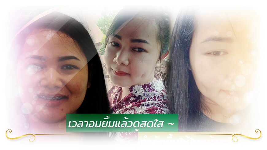 โรงพยาบาลเลอลักษณ์ ทำลักยิ้ม โดยคุณหมอวาสิตา