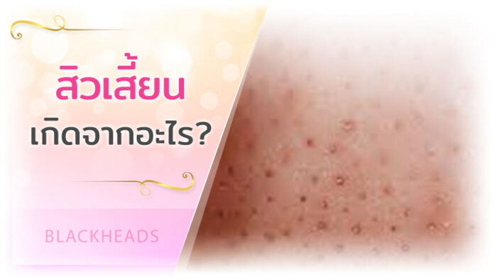 สิวเสี้ยน เกิดจากอะไร วิธีลดสิวเสี้ยนอย่างเห็นผล