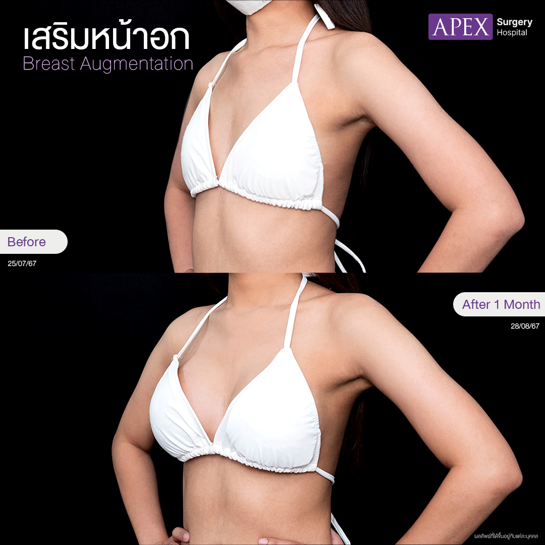 breast-augmentation 2025