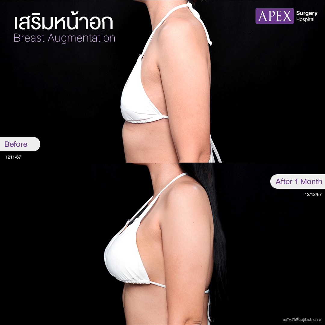breast-augmentation 2025