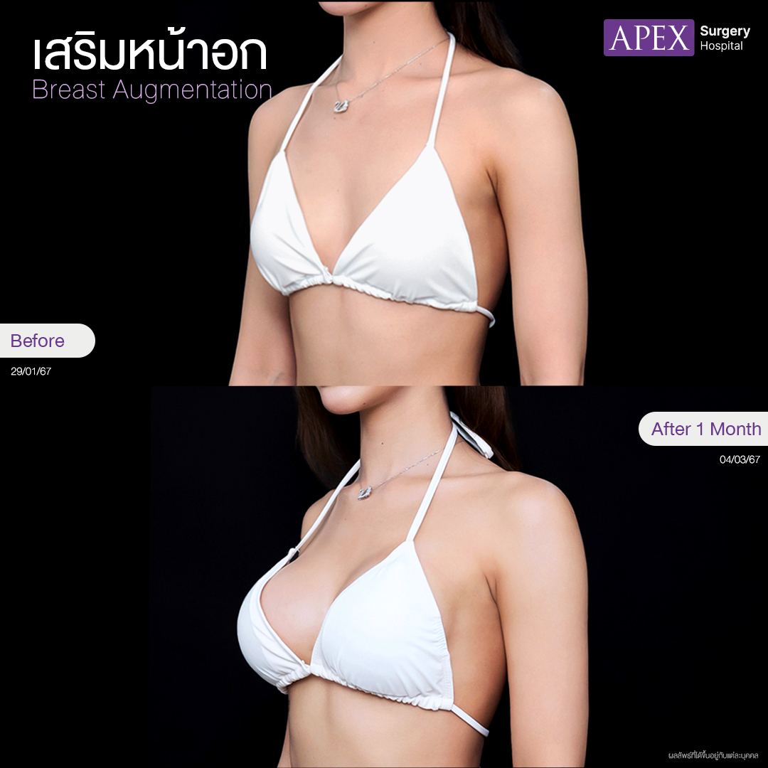 breast-augmentation 2025