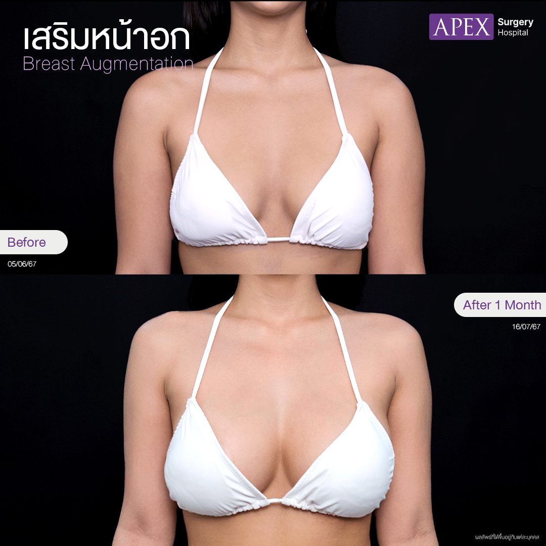 breast-augmentation 2025