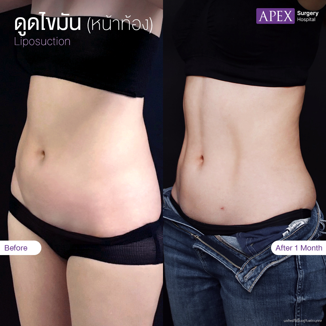 liposuction-2025
