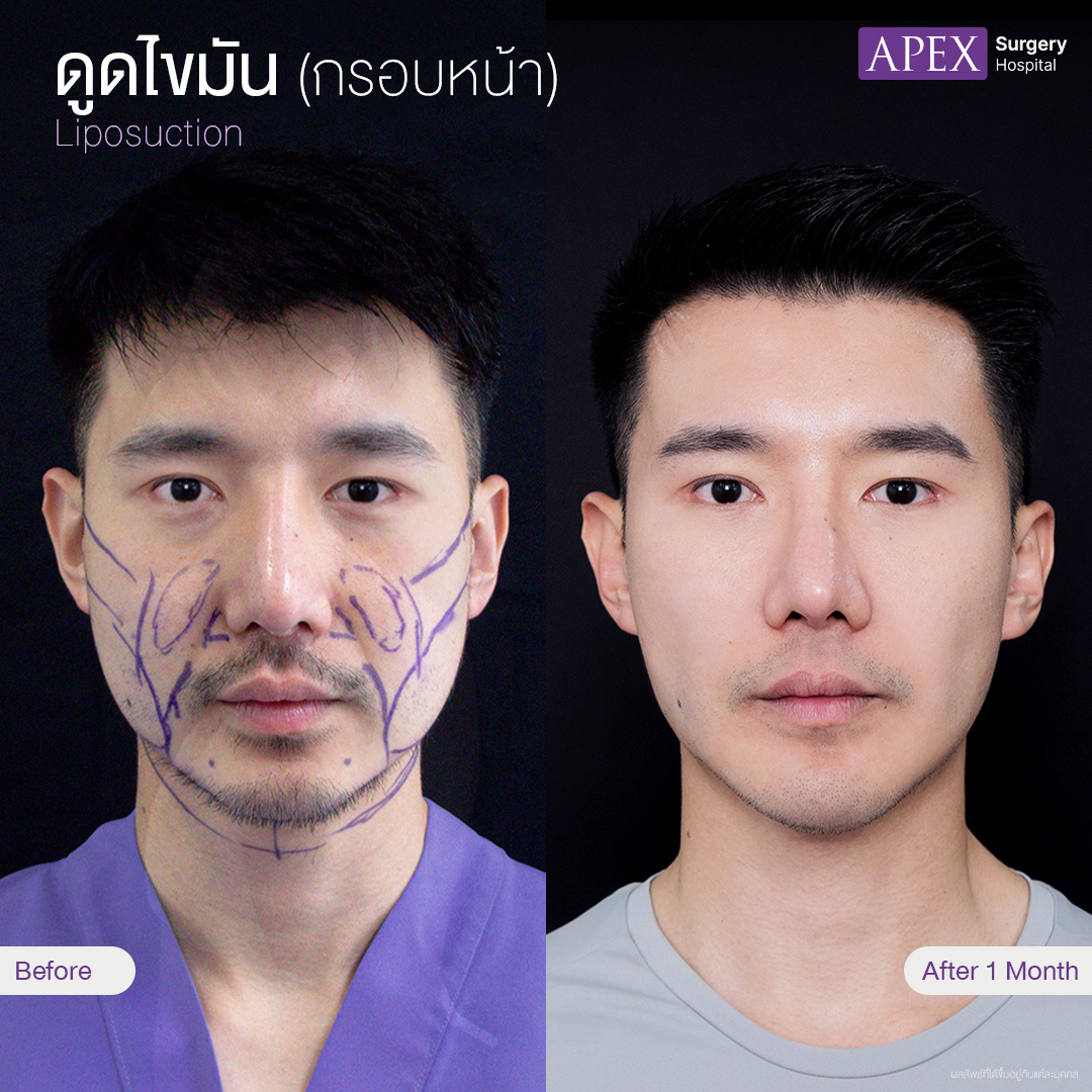 liposuction-2025
