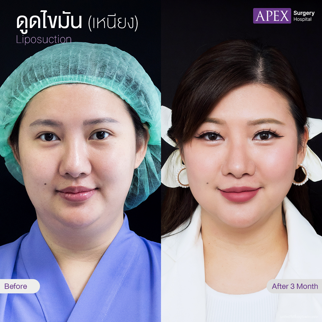 liposuction-2025