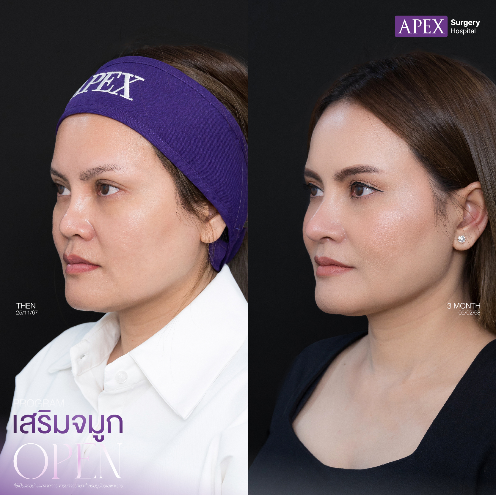 คลินิก เสริมจมูก ที่ดีที่สุด