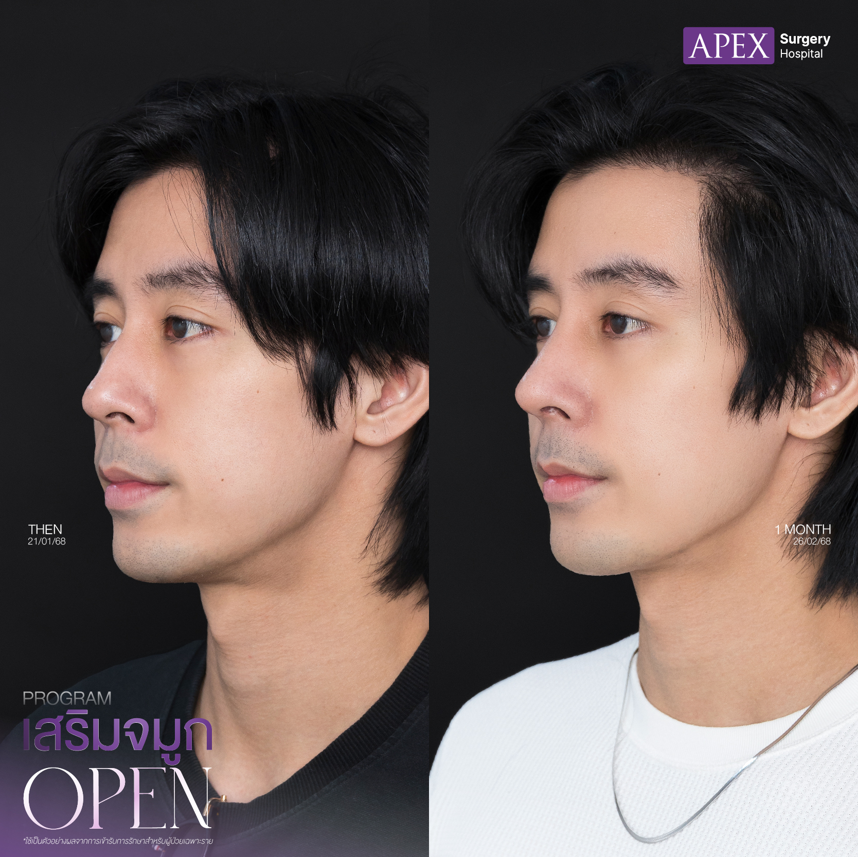 nose-surgery-2025-1