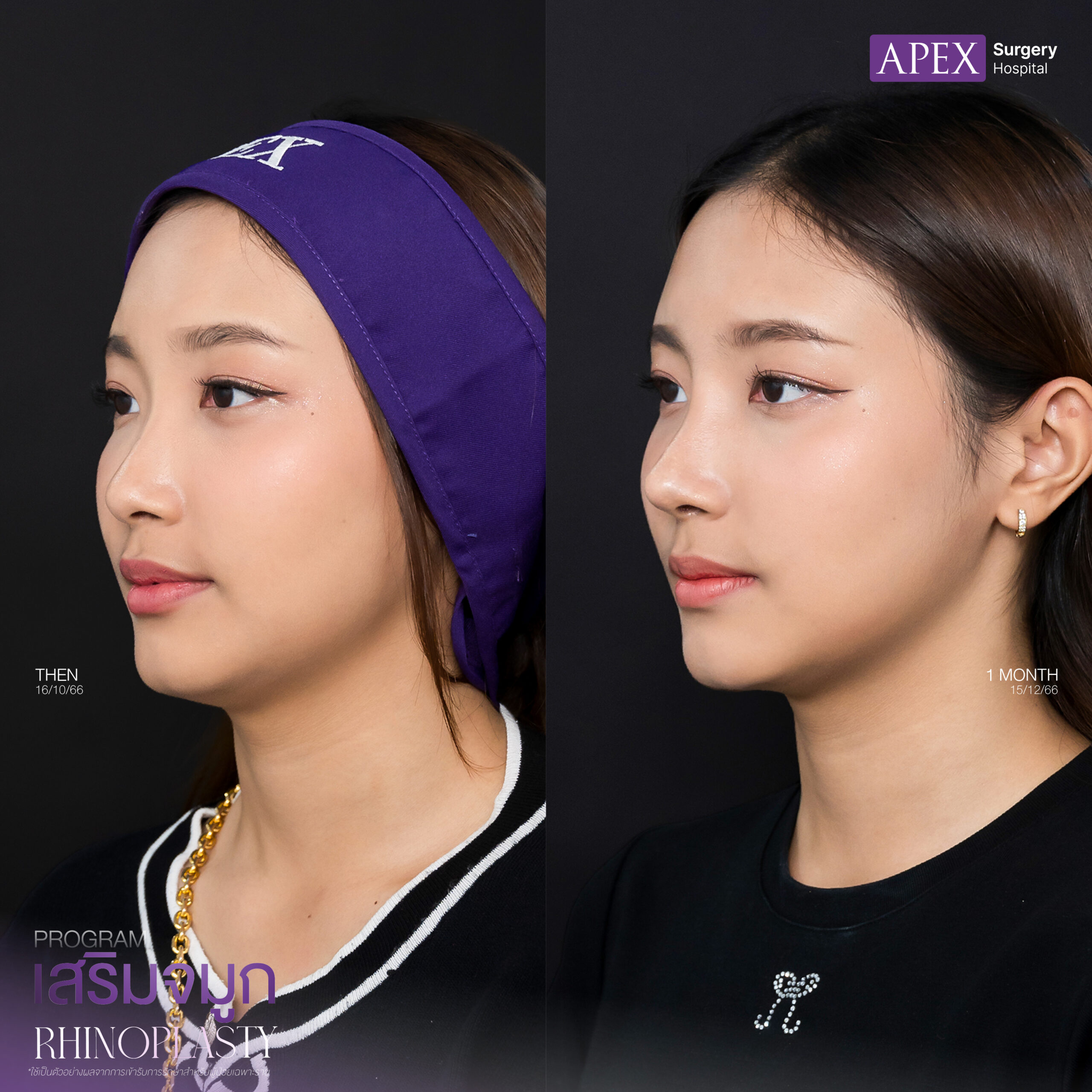 คลินิก เสริมจมูก ที่ดีที่สุด